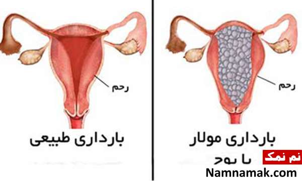 علائم بارداری مولار