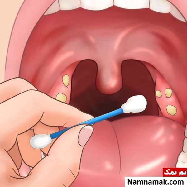 درمان قطعی سنگ لوزه با جراحی و طب سنتی و اسلامی