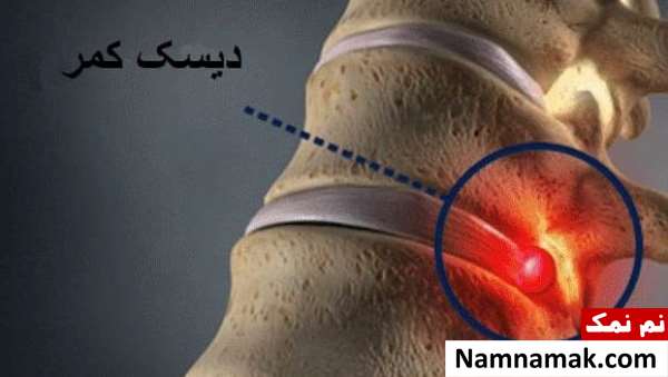 ورزش برای دیسک کمر و بی حسی پا