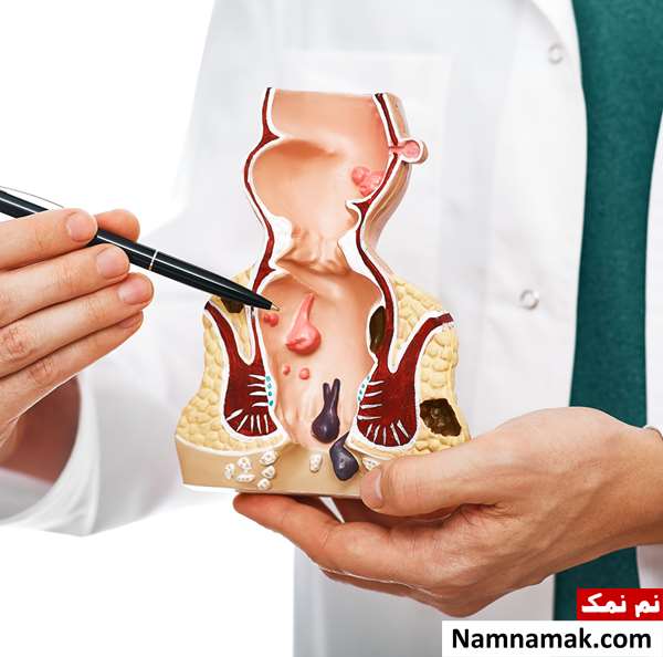 درمان شقاق با طب اسلامی