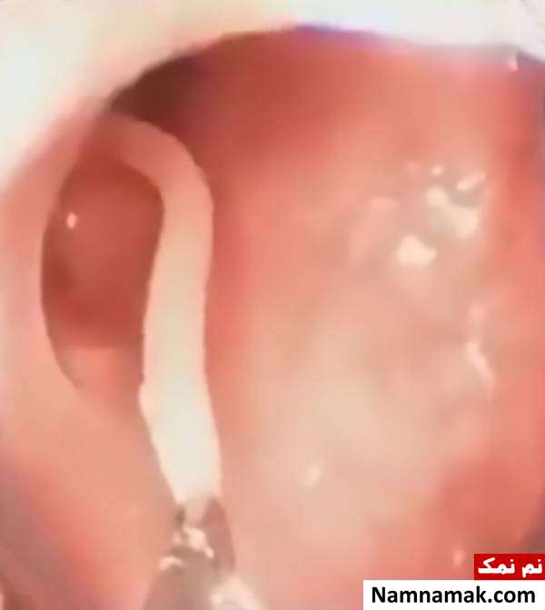 خارج کردن کرم 10 ساله از روده بیمار !