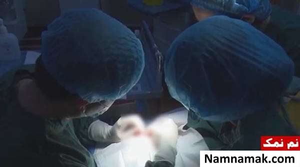 خارج کردن توپ های آهنربا از شکم کودک!