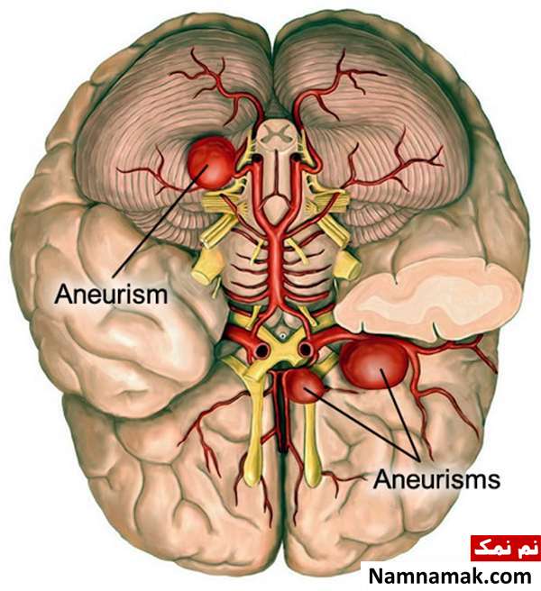 همه چیز درباره عمل انوریسم مغزی