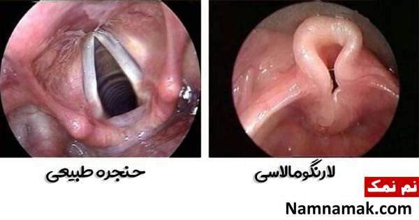 علت صدای کم گریه نوزاد و درمان اختلالات صوت در کودکان لارنگومالاسی (نرمی حنجره)