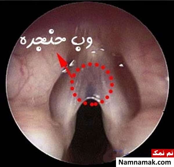 علت صدای کم گریه نوزاد و درمان اختلالات صوت در کودکان وب تار صوتی