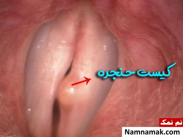 علت صدای کم گریه نوزاد و درمان اختلالات صوت در کودکان کیست تار صوتی