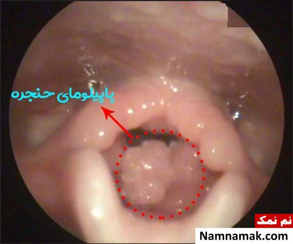 علت صدای کم گریه نوزاد و درمان اختلالات صوت در کودکان پاپیلوما حنجره کودکان