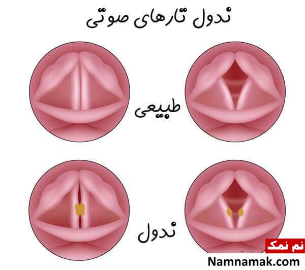 علت صدای کم گریه نوزاد و درمان اختلالات صوت در کودکان ندول حنجره