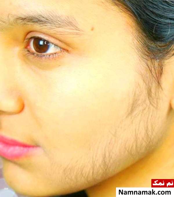 علت موهای زائد زنان