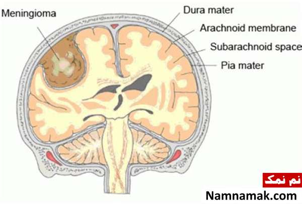 علائم مننژیوما و درمان و عوارض جراحی تومور مغزی مننژیوم علائم مننژیوما و درمان و عوارض جراحی تومور مغزی مننژیوم
