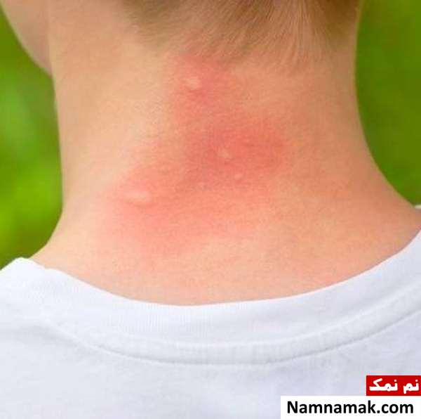 درمان نیش حشرات راه های درمان نیش مورچه