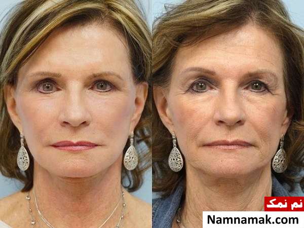 تزریق چربی به صورت ، سینه و باسن چگونه انجام میشود؟ تزریق چربی به صورت ، سینه و باسن چگونه انجام میشود؟