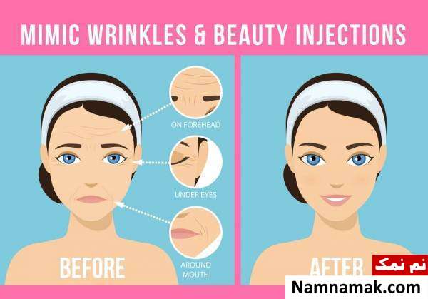 آنچه باید به هنگام تزریق بوتاکس بدانید آنچه باید به هنگام تزریق بوتاکس بدانید