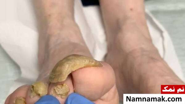 کوتاه نکردن ناخن های پا