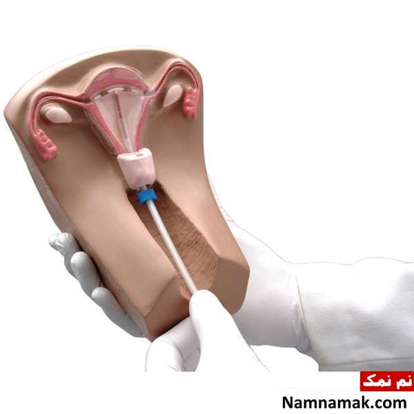 احتمال سقط جنین با وجود آی یو دی چقدر است؟ احتمال سقط جنین با وجود آی یو دی چقدر است؟