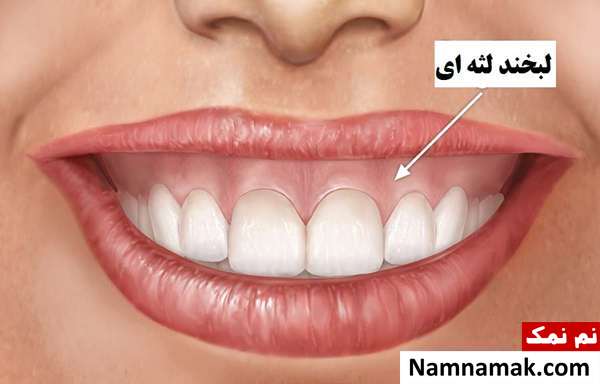 معرفی بهترین روش های اصلاح طرح لبخند