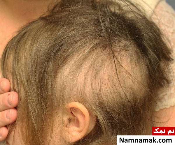کچلی کودک اختلال کندن موی سر