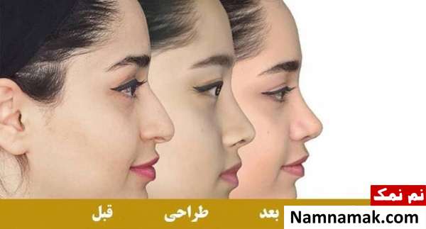 عمل زیبایی بینی با اسکن سه بعدی با قالب کنترلی