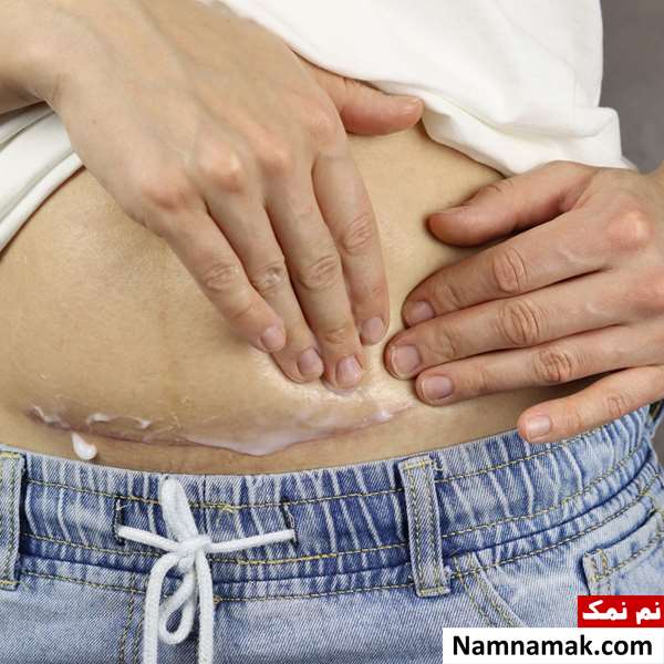 چکار کنیم زخم سزارین زود خوب بشه