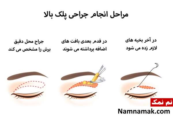 روش های رفع جای بخیه عمل پلک