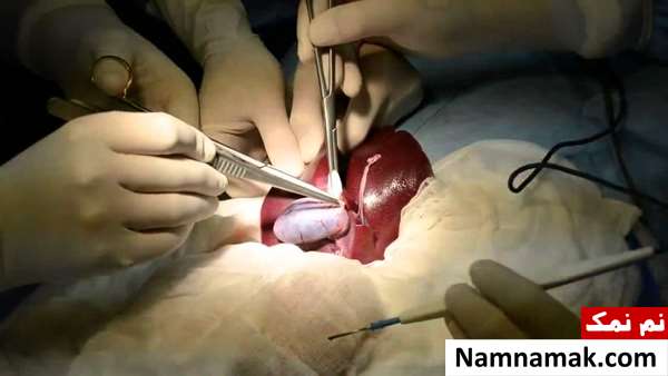 زمان عمل باز کیسه صفرا