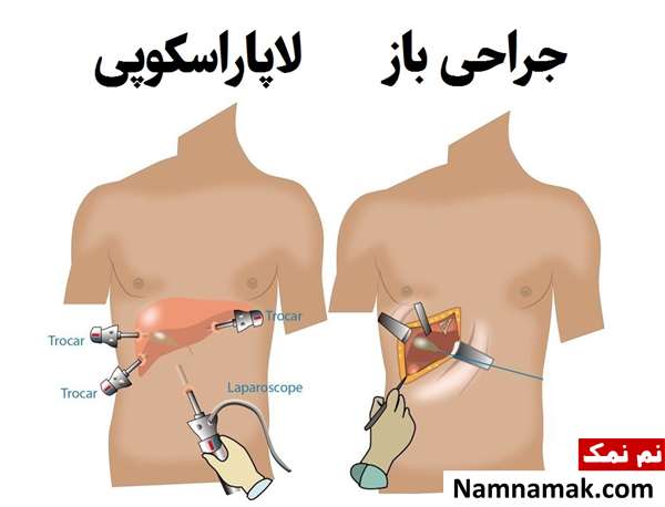 زمان عمل باز کیسه صفرا