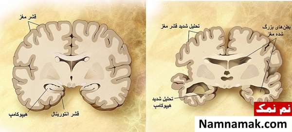 علت مرگ در آلزایمر