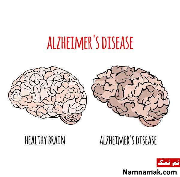 عکس بیماری آلزایمر