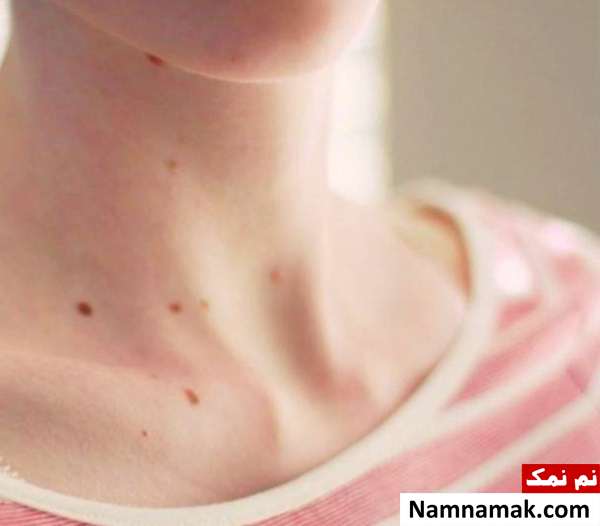 ملانوما چیست؟ مشخصات خال های سرطانی (ملانوما)