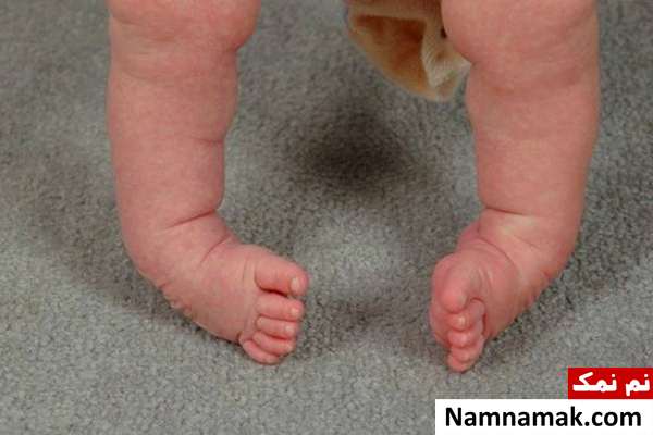 پا چنبری نوزادان انواع پاچنبری نوزاد