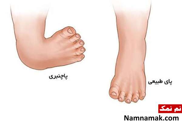علایم پاچنبری پاچنبری در نوزادان
