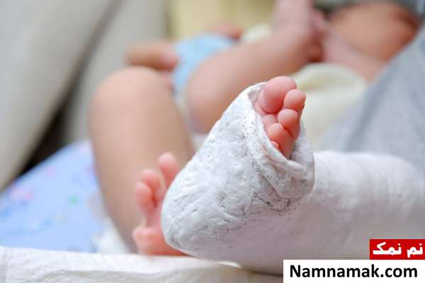 روش پونستی درمان کلاب فوت با روش پونستی