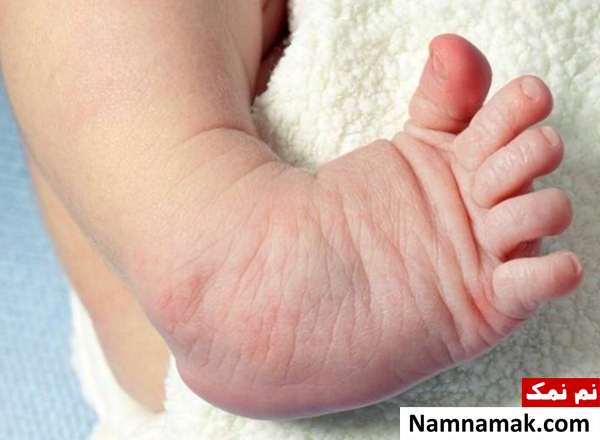 دلیل کج شدن پای نوزاد