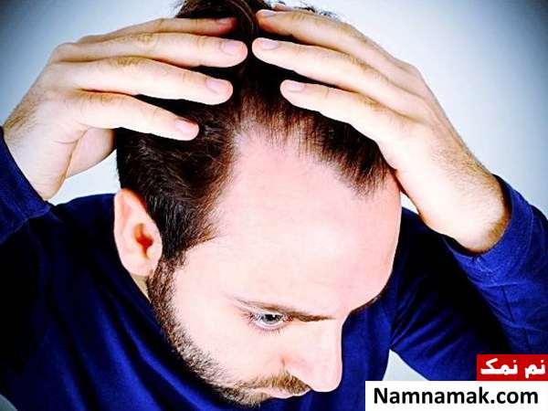 ریزش مو ریزش مو از علائم کمبود تستوسترون