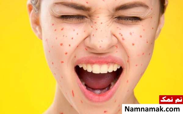 خطرات آبله مرغان در بارداری