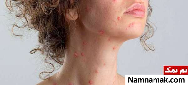 عوارض آبله مرغان دوران بارداری چیست؟