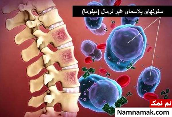 سرطان خون سرطان میلوما