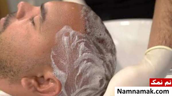 شستشوی مو بعد از عمل کاشت مو