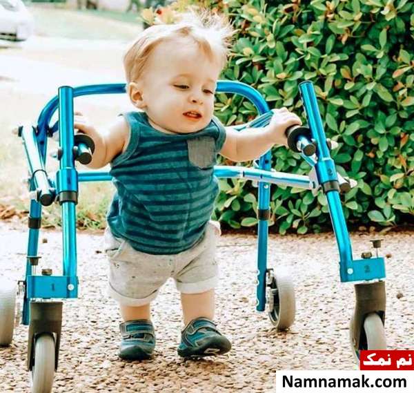 بیماری کوتولگی یا آکندروپلازی