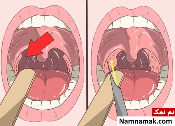 چگونه سنگ لوزه را خارج کنیم؟