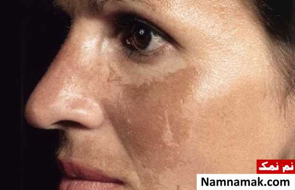 انواع لکه های پوستی با تصویر انواع لکه های پوستی با تصویر
