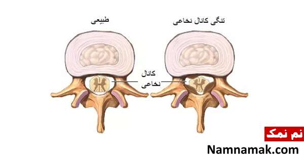 بیماری و مشکلات ستون فقرات : علائم ، تشخیص و درمان بیماری و مشکلات ستون فقرات : علائم ، تشخیص و درمان