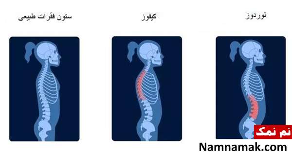 بیماری و مشکلات ستون فقرات : علائم ، تشخیص و درمان بیماری و مشکلات ستون فقرات : علائم ، تشخیص و درمان