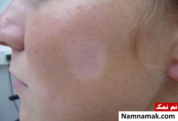 انواع لکه های پوستی با تصویر انواع لکه های پوستی با تصویر