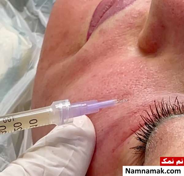 عکس پی آر پی صورت 