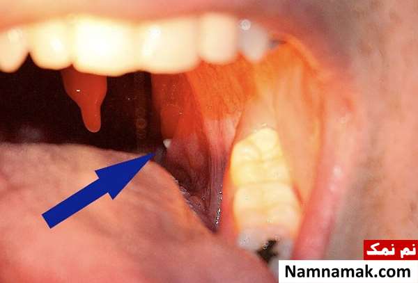 نحوه استفاده از دهانشویه برای سنگ لوزه برای پیشگیری و درمان