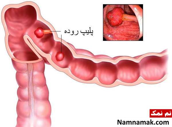 علت به وجود امدن پولیپ روده 