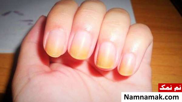 علت زردی ناخن دلیل زردی ناخن چیست؟
