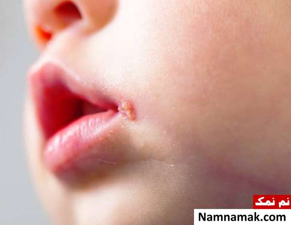 علت بروز آفت دهانی