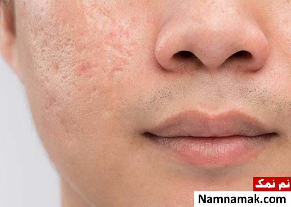 سابسیژن سابسیژن چیست؟